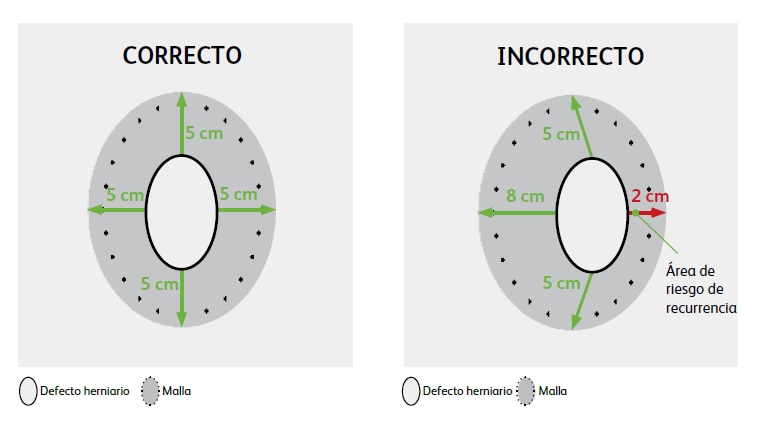 Accurate mesh overlap and centering can improve results